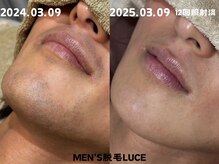 ルーチェ/【ヒゲ脱毛】卒業目前★