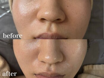 ホワイトアクア 北千住店(WHITE AQUA)/ハーブピーリング/毛穴