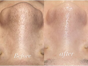 レシェルサロン(Lechelle Salon)/ハーブピーリング+ダーマエステ