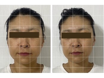 シャンタイン(SANTAI)/圧倒的小顔★美顔器リフト