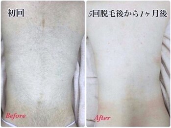 フローラル ビューティー(Floral-Beauty)/【背中脱毛】美肌脱毛/部分脱毛