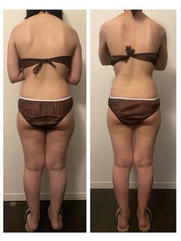 ベルミナ(Belmina)/大名/天神/毛穴/脱毛/痩身