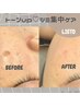 LIETO1番人気！他ではできない【★シミ集中ケア★】今だけ♪→初回￥5,000