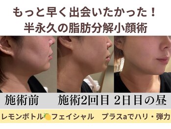 エス シークレット 金町店(S secret)の写真/【韓国発!SNSで話題のレモンボトル導入】半永久小顔フェイシャル9800円★たるみ改善/脂肪分解ケア/即小顔!