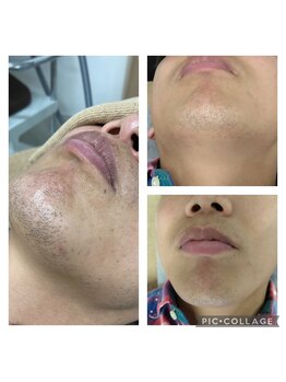 グラース(grace)/ヒゲ脱毛！抜け感◎満足度◎