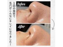 ポノ(pono)/バイバイ毛穴