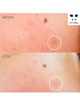 エミリー 守山(EMILY)/【症例写真】シミ取リ放題 (1)