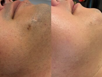 モナートドゥ(Monartdeux)/メンズ髭脱毛