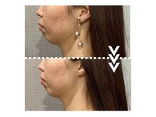 リエイト(Re:eight)/マイクロウェーブリフト2回施術