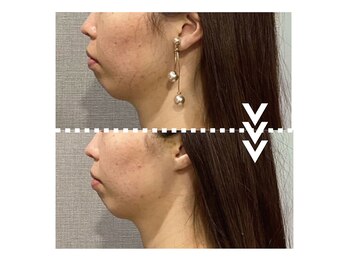 リエイト(Re:eight)/マイクロウェーブリフト2回施術