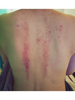 イニティウム 清澄白河(initium)/深部まで届くスライドカッピング