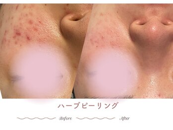 エステティックサロン シーズ/繰り返す肌荒れに
