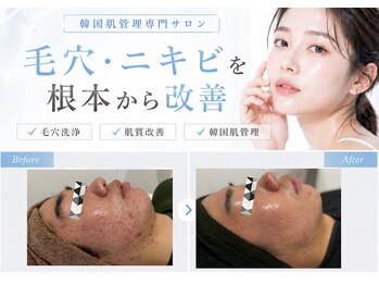 ユアーズ ビューティー(YOURS beauty)の写真/毛穴・ニキビを根本からケア。憧れの韓国女優のような透明感あふれる水光ツヤ肌へ導きます
