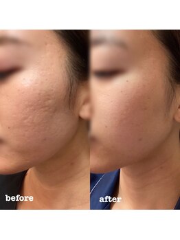 ベベ 金沢本店(Be'be')/お肌変化.3