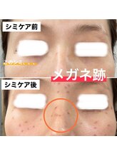 モイラ(MOIRA)/メガネ跡に注意！