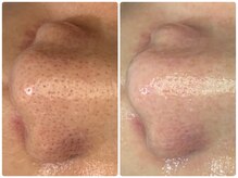 カンナ(Kanna)/毛穴洗浄でもうイチゴ鼻卒業！