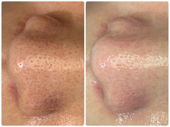 カンナ(Kanna)/毛穴洗浄でもうイチゴ鼻卒業!