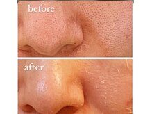 ジーニー(Genie)/脱皮して「毛穴レス」？！