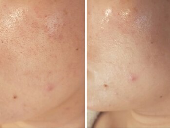 ベリッセ(Belisse)/ハイドラ毛穴洗浄×LALAピール