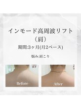 メディカルエステ 恵比寿店/＊インモード肩症例＊