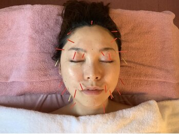 ベルマーノ 薬院店の写真/圧倒的小顔を実現☆【美容鍼初回¥3700】お悩みに多いほうれい線やたるみを改善！ハリ・弾力のあるお肌へ♪