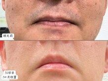 セルフメイド 東大阪店(SELFMADE)/髭脱毛♪見た目も10歳若く見える