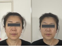 ブプラ 相模大野店(BUPURA)/歪みたるみ改善♪