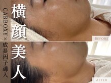 アポシェ(apoche)/リフトアップ/輪郭/小顔/透明感