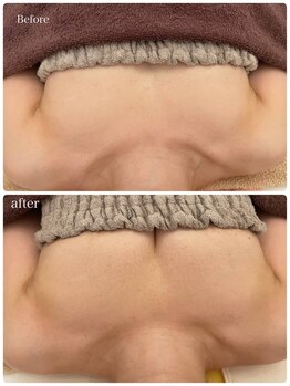 美人バスト 浜松店/◆バストアップ BeforeAfter◆