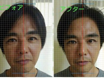 泉町鍼灸整骨院/美容鍼ビフォー→アフター