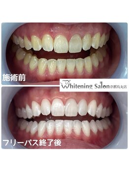 ホワイトニングサロン 京都烏丸店/ホワイトニング施術例
