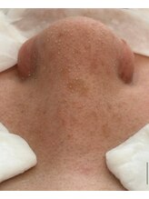 ルチル(Rutile)/韓国式3D毛穴洗浄