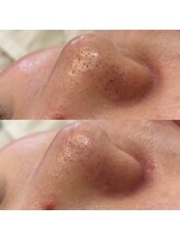 メゾンリュバン 梅田店(Maison Ruban)/毛穴洗浄・美白フォト|毛穴ケア