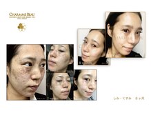 アムレット(Amourette)/CHARMME BEAUホームケアで肌改善