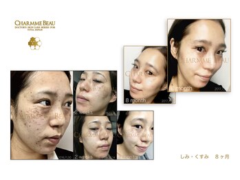 アムレット(Amourette)/CHARMME BEAUホームケアで肌改善