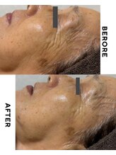 ゼロ 水戸店(ZERO)/シミ・シワ肌質改善スペシャル