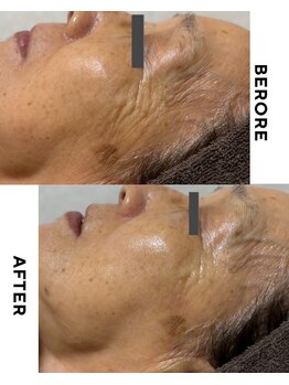 ゼロ 水戸店(ZERO)/シミ・シワ肌質改善スペシャル