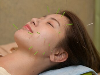 エイトはり きゅう院/美容鍼は男女問わず人気です♪