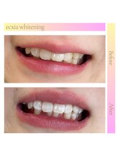 エクシアホワイト 平岸駅前店/ホワイトニングビフォーアフター