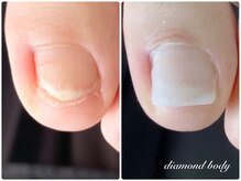 ダイヤモンドボディ/トラブルネイル