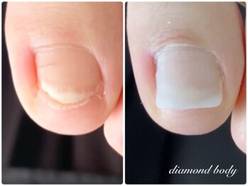 トラブルネイル