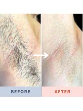 美バリ 新宿店(美BARI)/同じ個所は5日開ければ施術可能