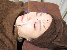 美リレア/大人気☆美容鍼