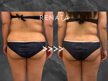 レナータ 銀座店(RENATA)/【脂肪冷却】経過写真
