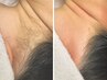 【WAX+光】春季限定1,000円オフ！うなじトリプル脱毛★5,500円！