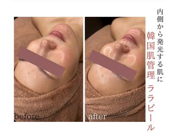 サロン ド ベル(Salon de Belle)/韓国流肌管理!ララピール