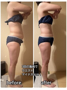 ヨサパーク ハット(YOSA PARK HAT)/ぽっこりお腹も減っこみます