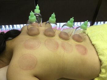 洪福寺鍼灸療院/抜罐療法