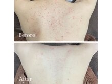 ニキビ研究所 千葉店の雰囲気（背中ニキビ！ブライダルにも大人気！！＃千葉駅＃ニキビ＃毛穴）