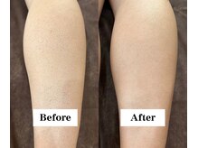 ワイイーサロン(Y/E SALON)/【40代男性　全身脱毛】